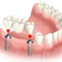 Делать ли имплантацию зубов?